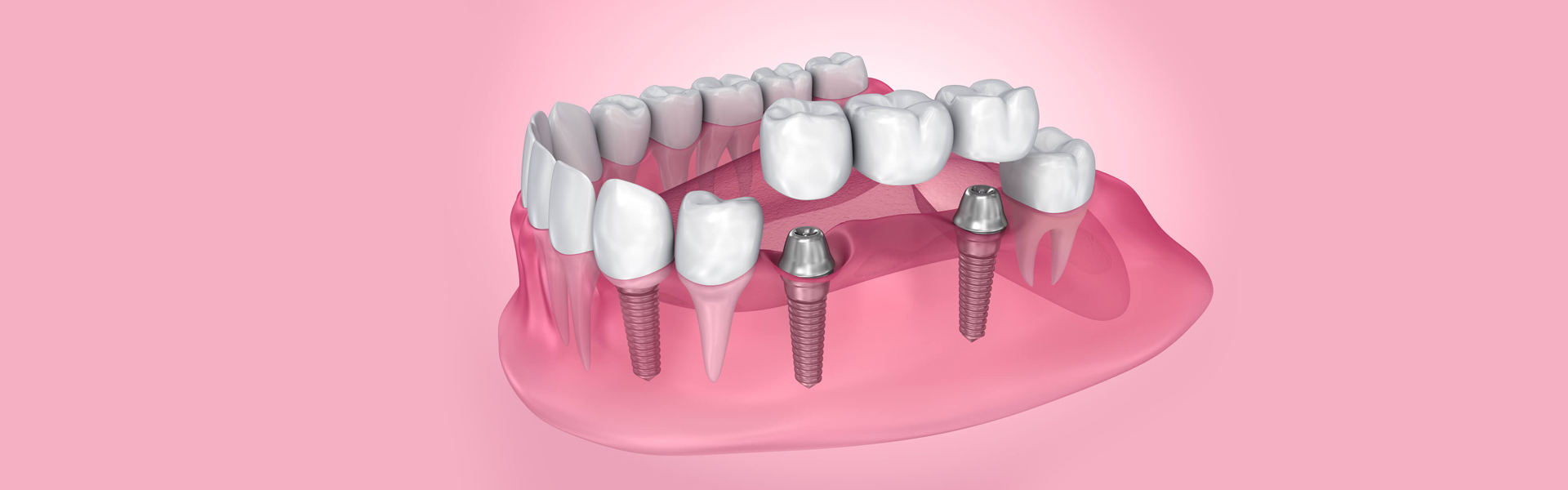 Bridge the Devastating Effects of Tooth Loss with Dental Bridges